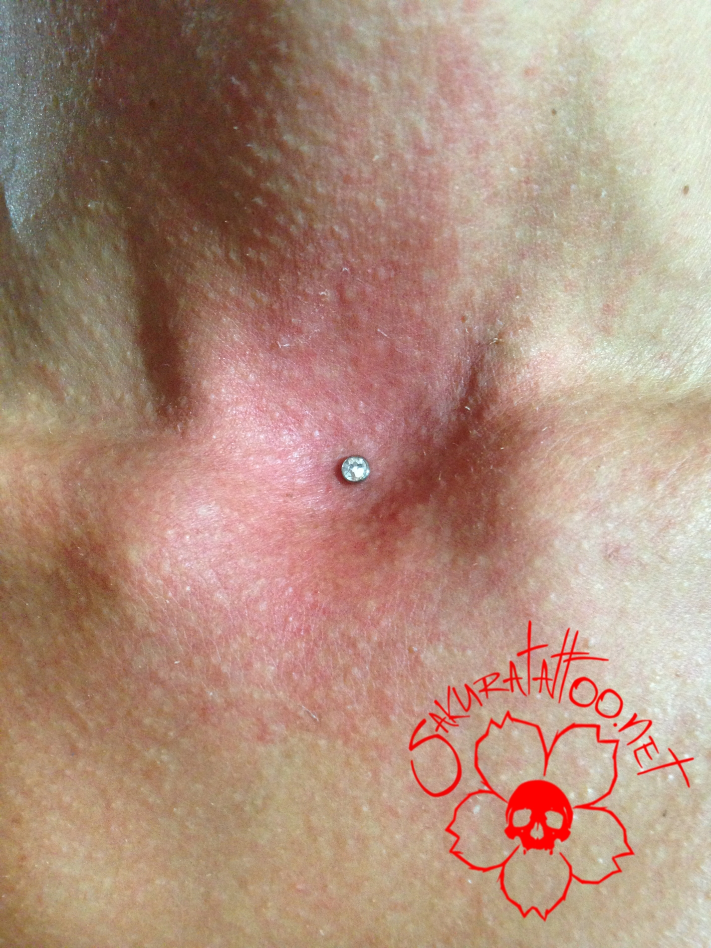 microdermal