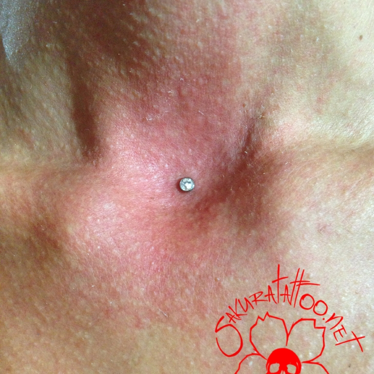 microdermal